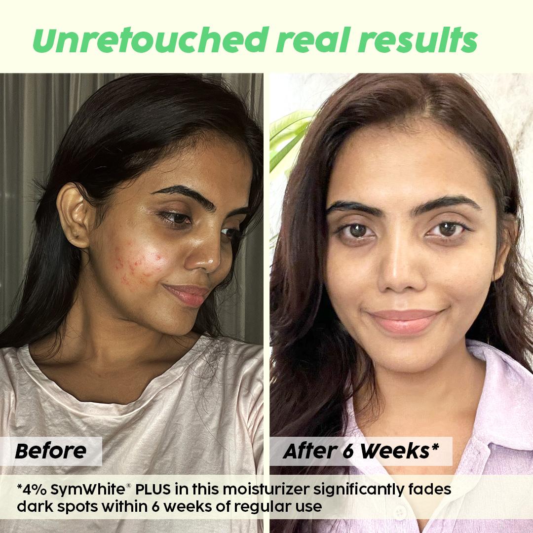 Pineapple Depigmentation Regime
