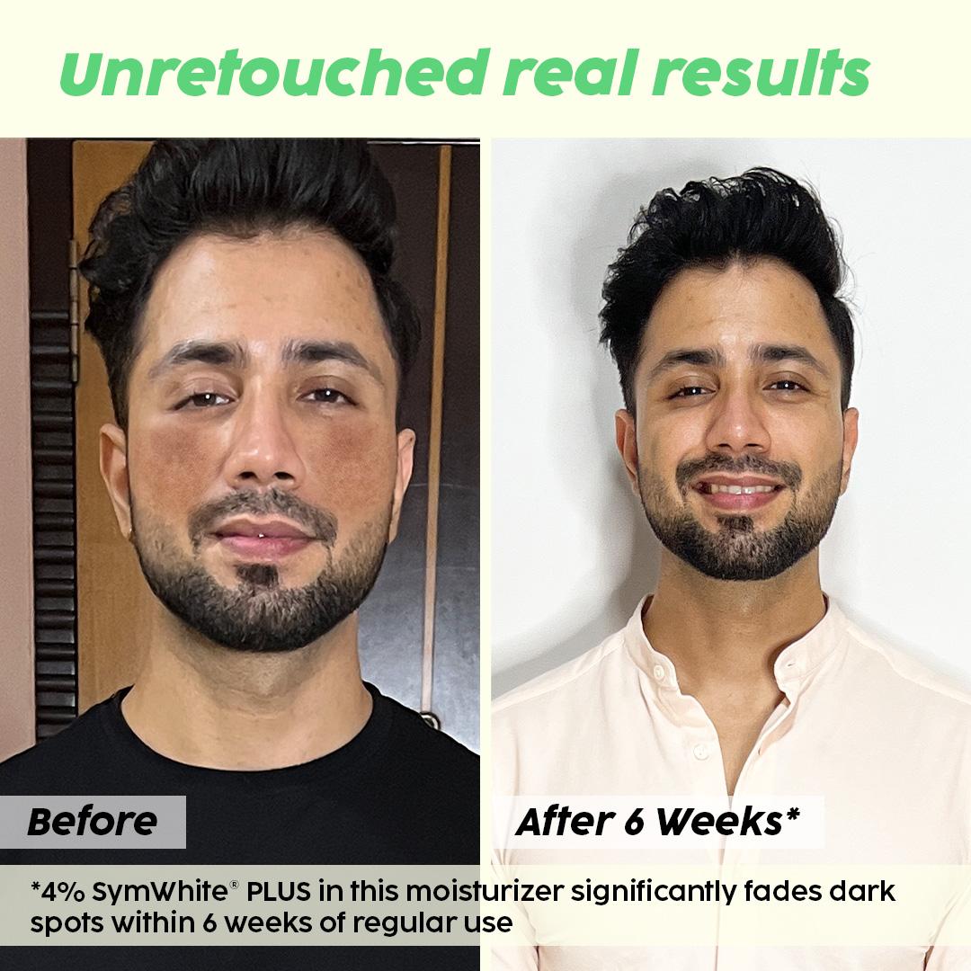 Pineapple Depigmentation Regime